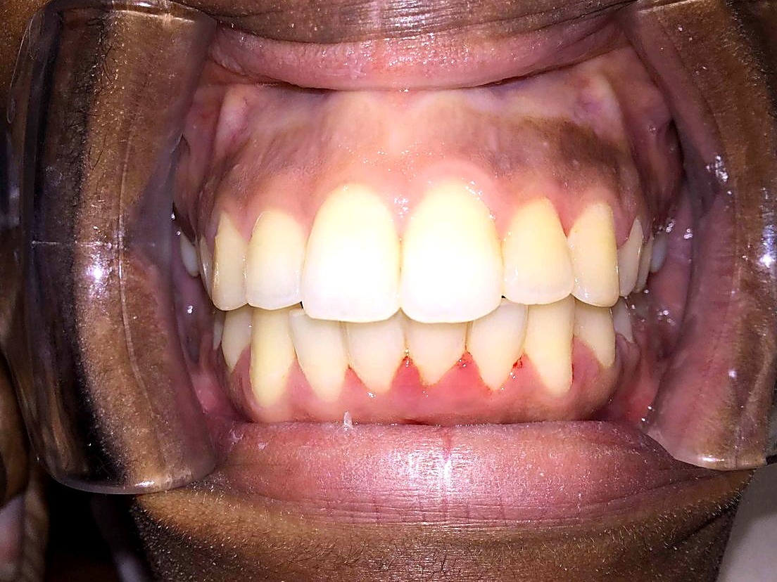 After treatment — aligned, even smile