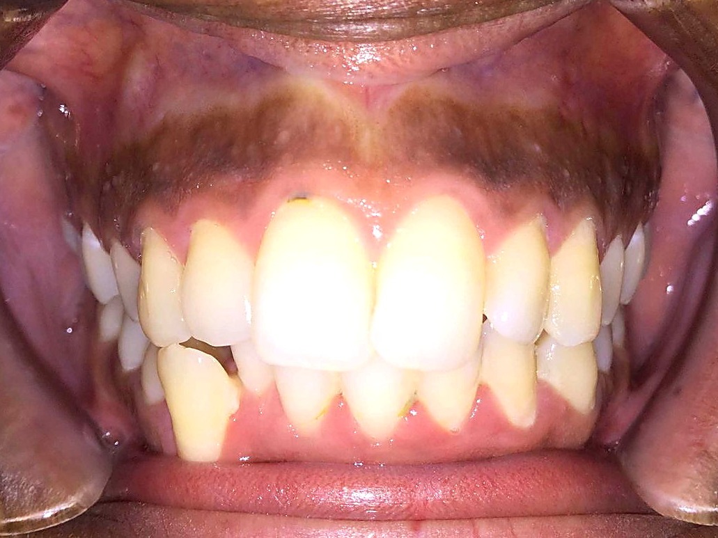 Before treatment — crowded, rotated lower front teeth
