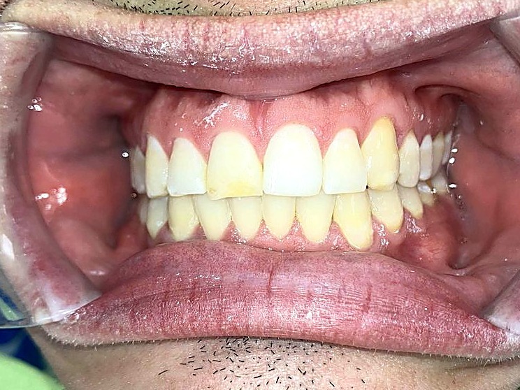 After treatment — evenly aligned arch
