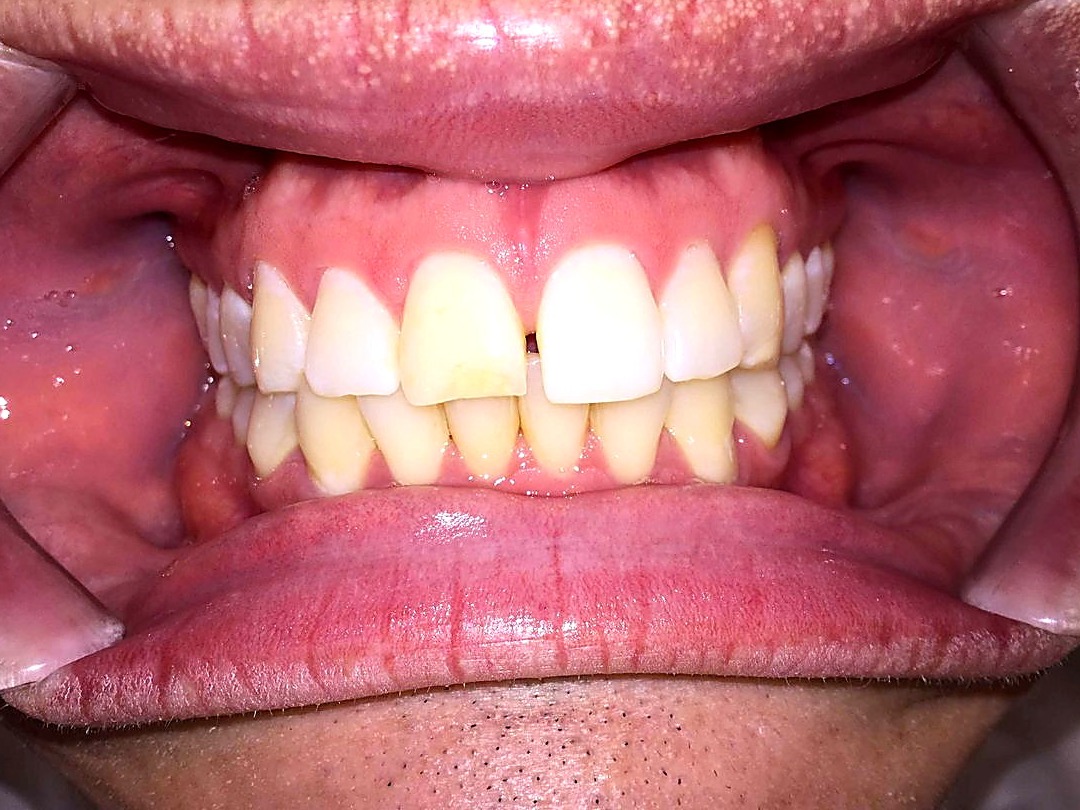 Before treatment — overlapping, crowded teeth