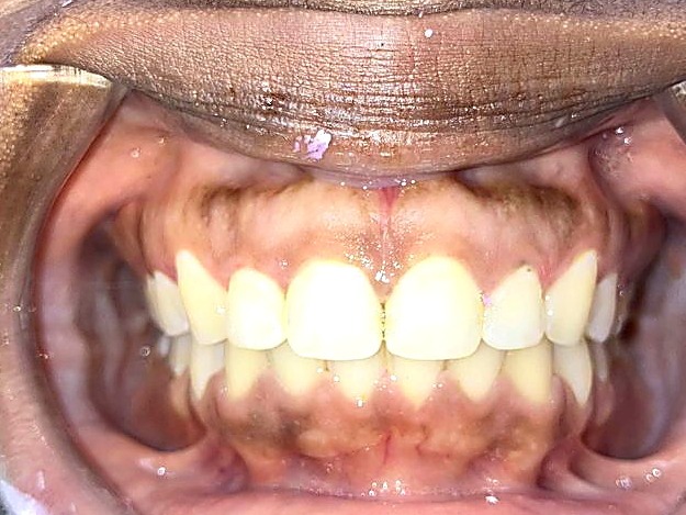 After treatment — broader, aligned smile
