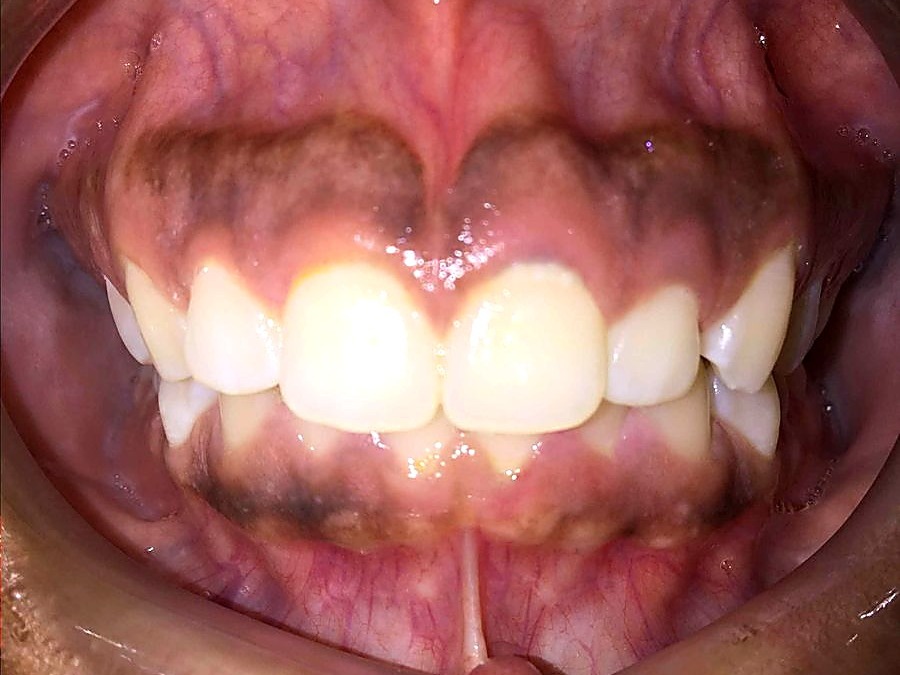 Before treatment — crowded upper and lower teeth