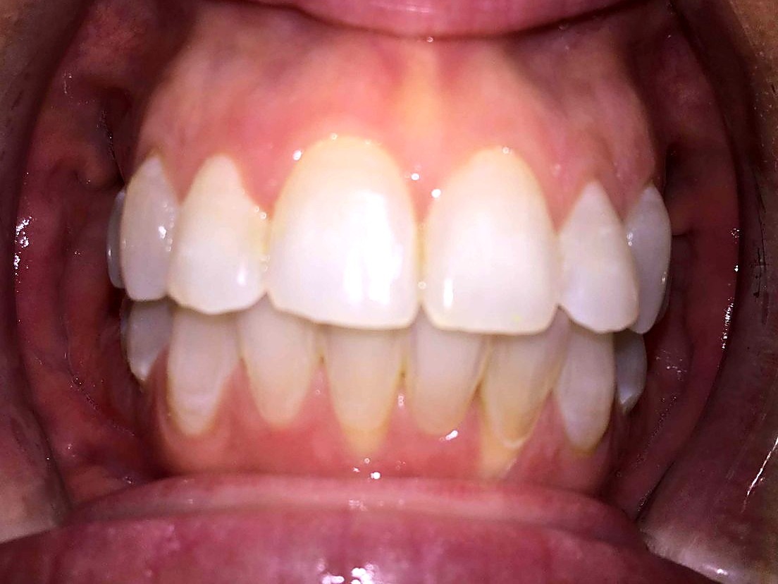 After treatment — straight, aligned teeth