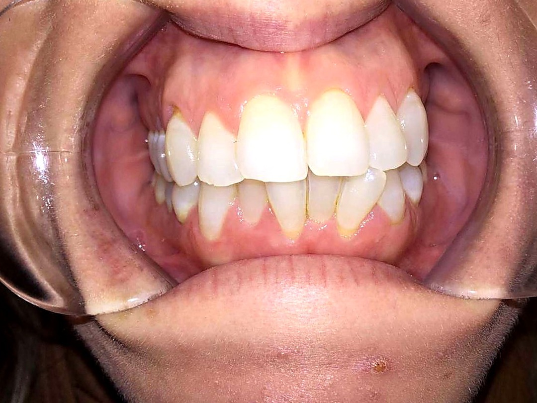 Before treatment — uneven, crowded teeth