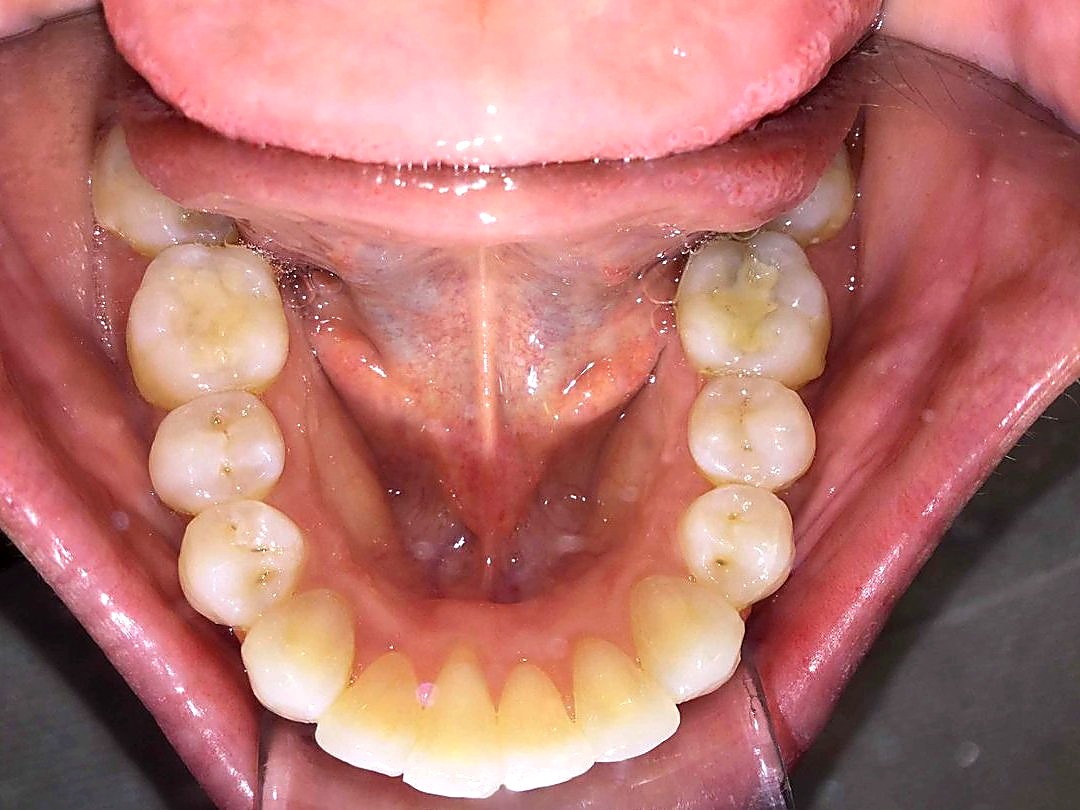 After treatment — aligned lower arch