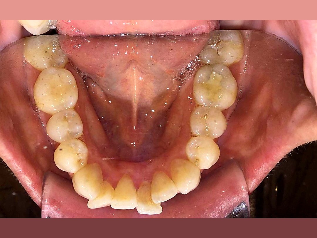 Before treatment — crowded lower arch