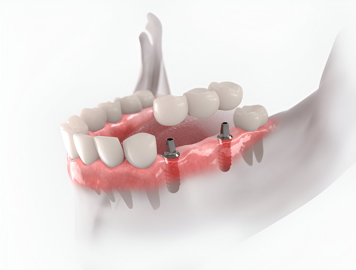 Dental Bridges in Coral Springs