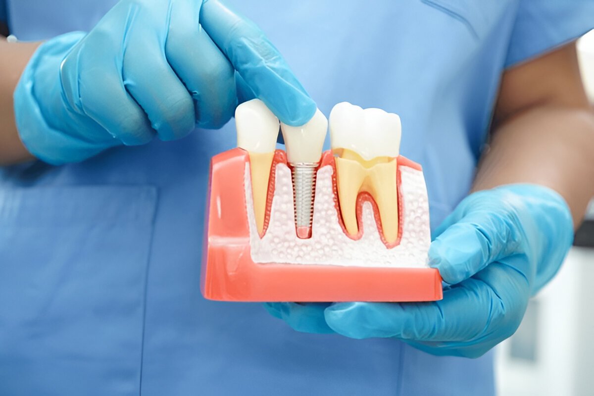 Dental Implants in Coral Springs