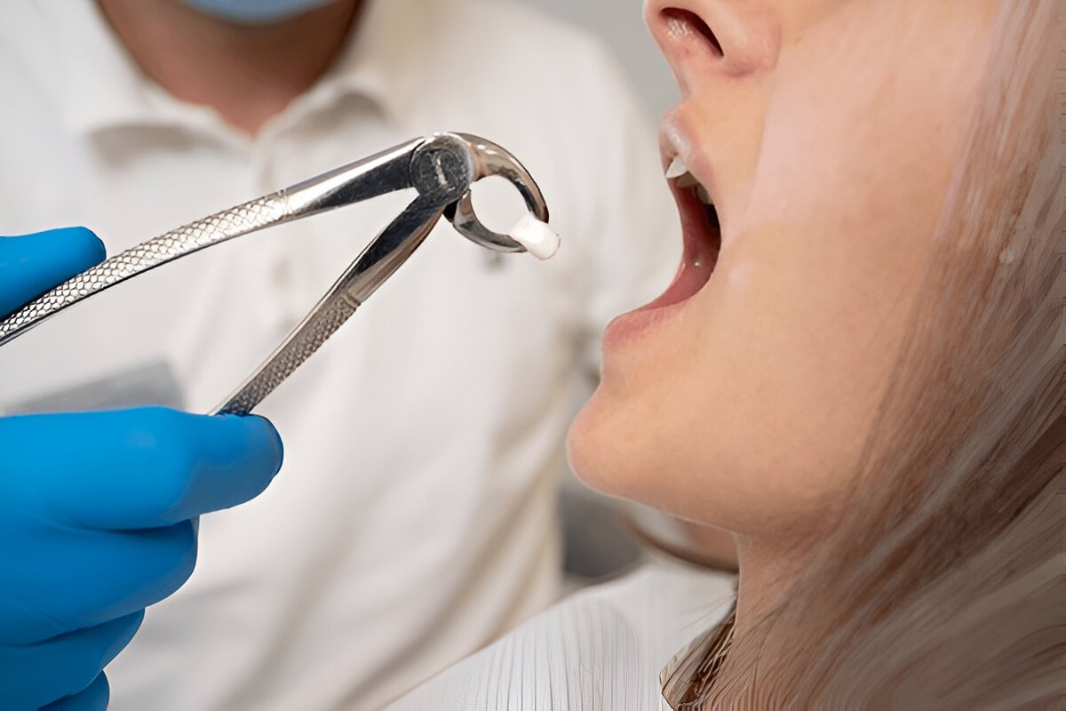 Tooth Extraction in Coral Springs