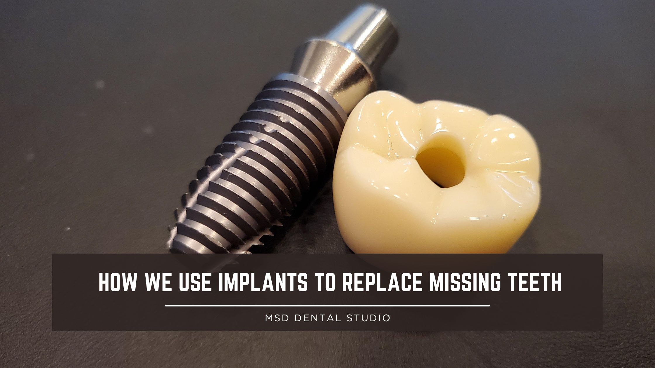 How We Use Implants to Replace Missing Teeth